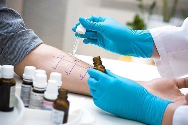 Médico com luvas azuis aplicando gotas em braço com grade desenhada para teste de alergia, com frascos em primeiro plano