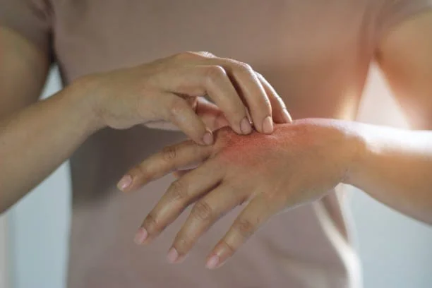Mão coçando outra mão com pele avermelhada e irritada